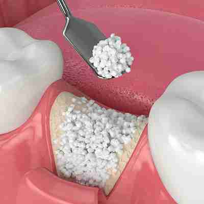 Bone Grafting bone grafting bring packed into empty tooth socket