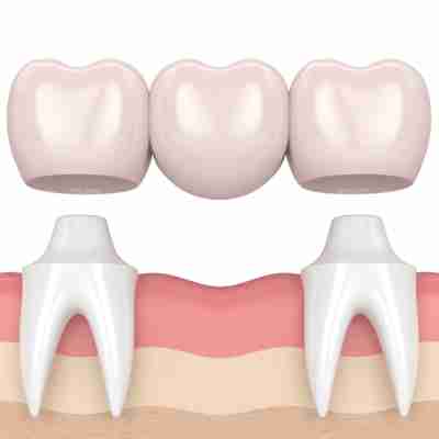 dental bridge hovering over prepared teeth ready to be seated