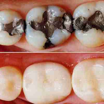 a before and after photo of amalgam and composite fillings