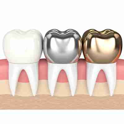 dental crowns displayed as porcelain, silver and gold options