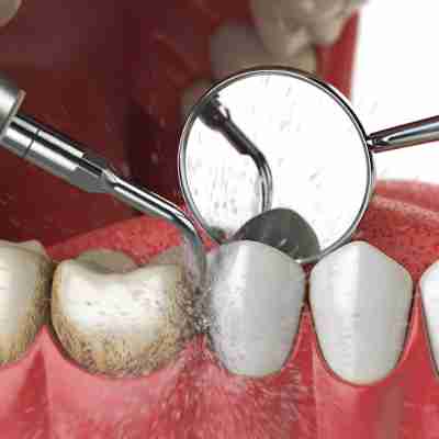 Dental Cleaning dental cleaning being performed on dirty teeth dental instrument is blasting plaque and tartar away