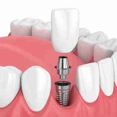 dental implants showcased by an implant entering the jaw line of an animated smile