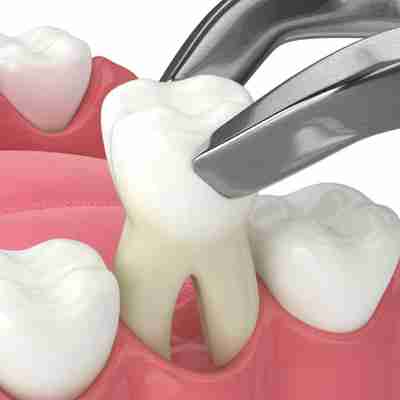 dental extractions showcased by a tooth being removed via dental tools