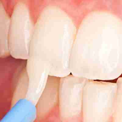 fluoride treatments being brushed onto the front teeth of a human female