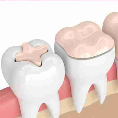 ceramic fillings, inlays and onlays being displayed in a animation showcasing each procedure accordingly