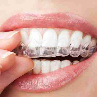 Invisalign a women removing her invisalign upper retainer