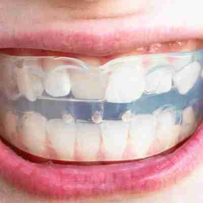 mouthguards being showcased by a patient biting down on one