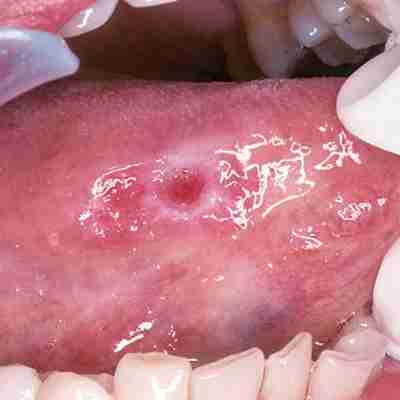 Oral Cancer Screenings oral cancer screenings showcasing a cancerous sore on a patients tongue