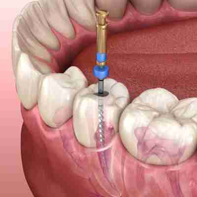 Root Canal Therapy a visualization of the bottom of a human jaw with teeth and a root canal therapy drill entering the tooth going deep into the root