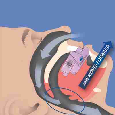Sleep Apnea Treatment An animated human male biting down on a sleep apnea treatment mouth guard
